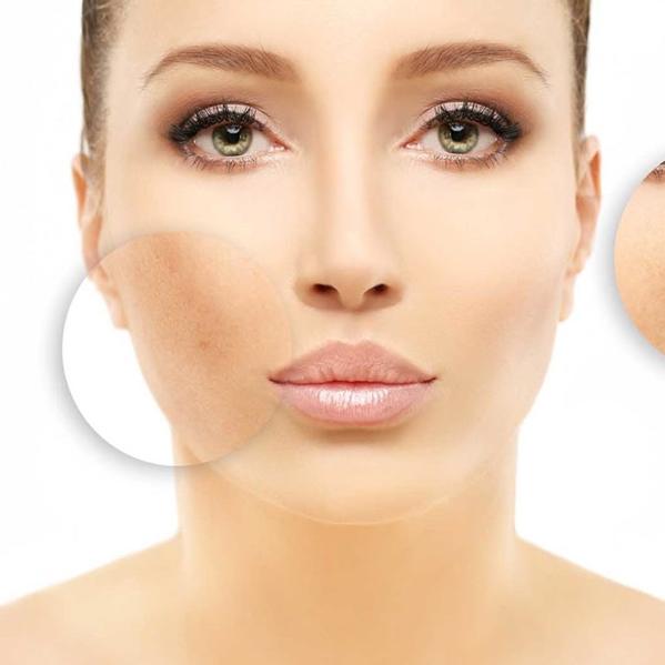 Micropeeling Manchas